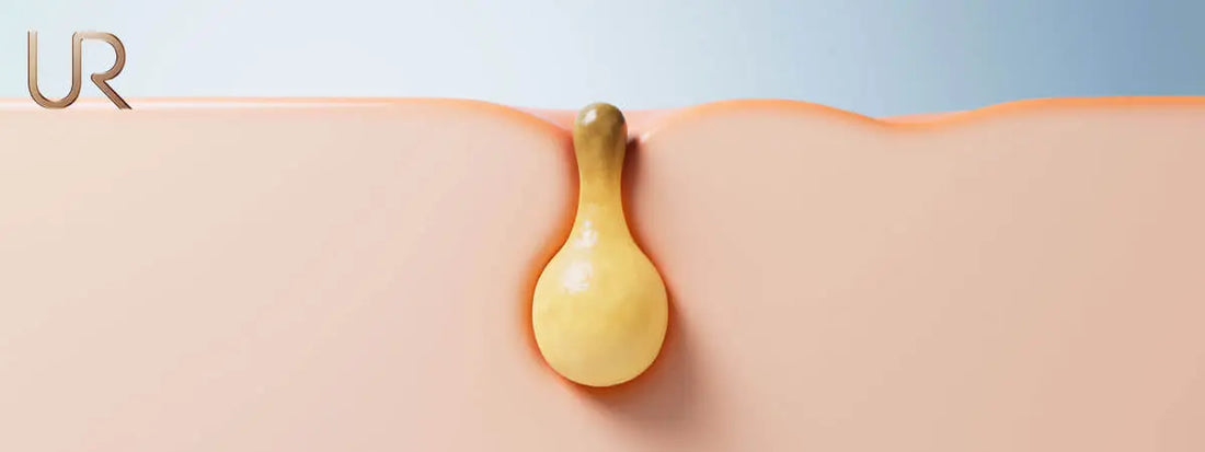 Cross section Illustration acne/pimples